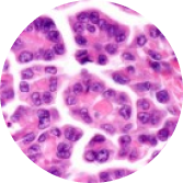 Epithelioid mesothelioma cell stain