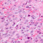 Epithelial mesothelioma cells