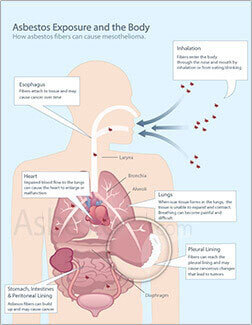 Exposure Diagram Thumbnail