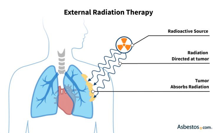 External beam radiation therapy for pleural mesothelioma