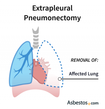 extrapleural pneumonectomy