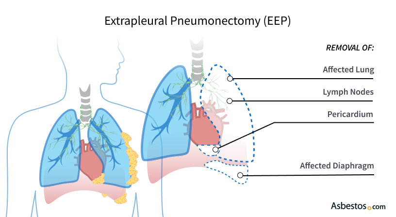 External beam radiation therapy for pleural mesothelioma