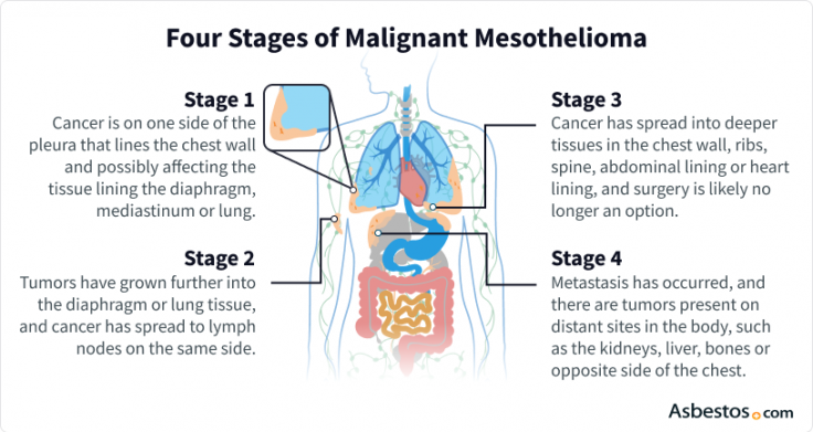 Diagram of the four stages of mesothelioma cancer
