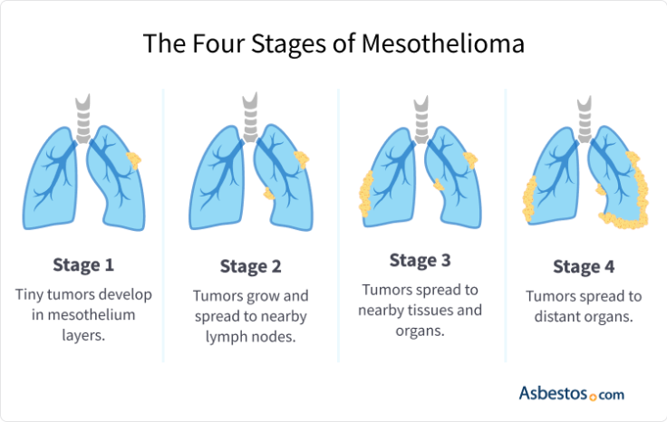 Graphic showing the four stages of mesothelioma.