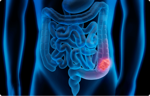 highlighted view of gastrointestinal cancer