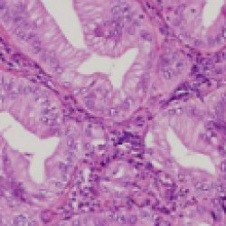 Glandular Mesothelioma Cells
