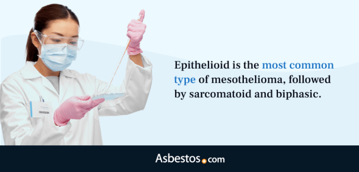 Epithelioid is the most common type of mesothelioma