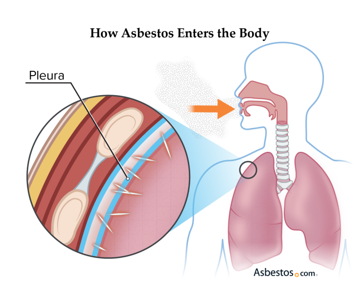 How Asbestos Exposure Affects the Body