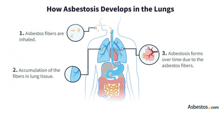 Asbestosis developing in the lungs