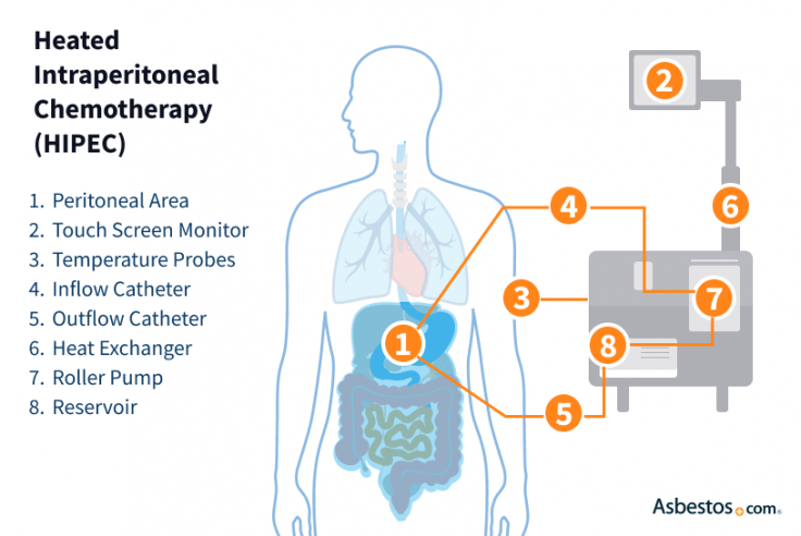Hyperthermic intrathoracic chemotherapy (HITHOC) treatment for pleural mesothelioma