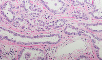 Micrograph of pleural mesothelioma