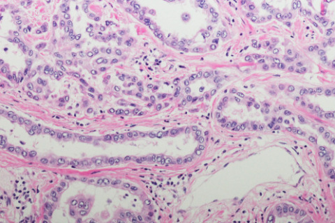 Micrograph of pleural mesothelioma