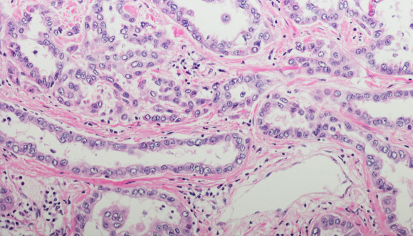 Micrograph of pleural mesothelioma