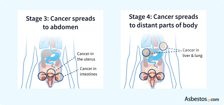 Comparing stage 3 and 4 ovarian cancer