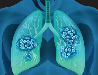 Illustration of lung cancer