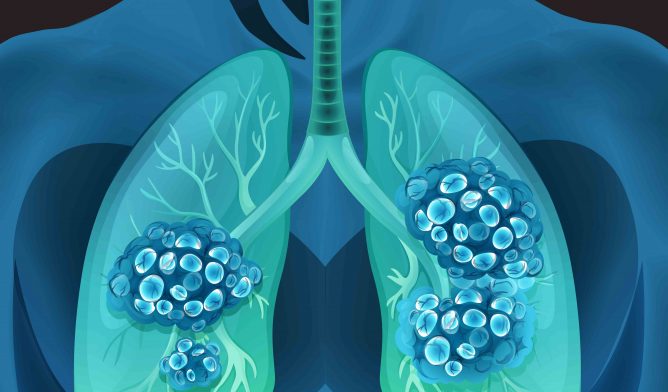 Lung cancer in human body