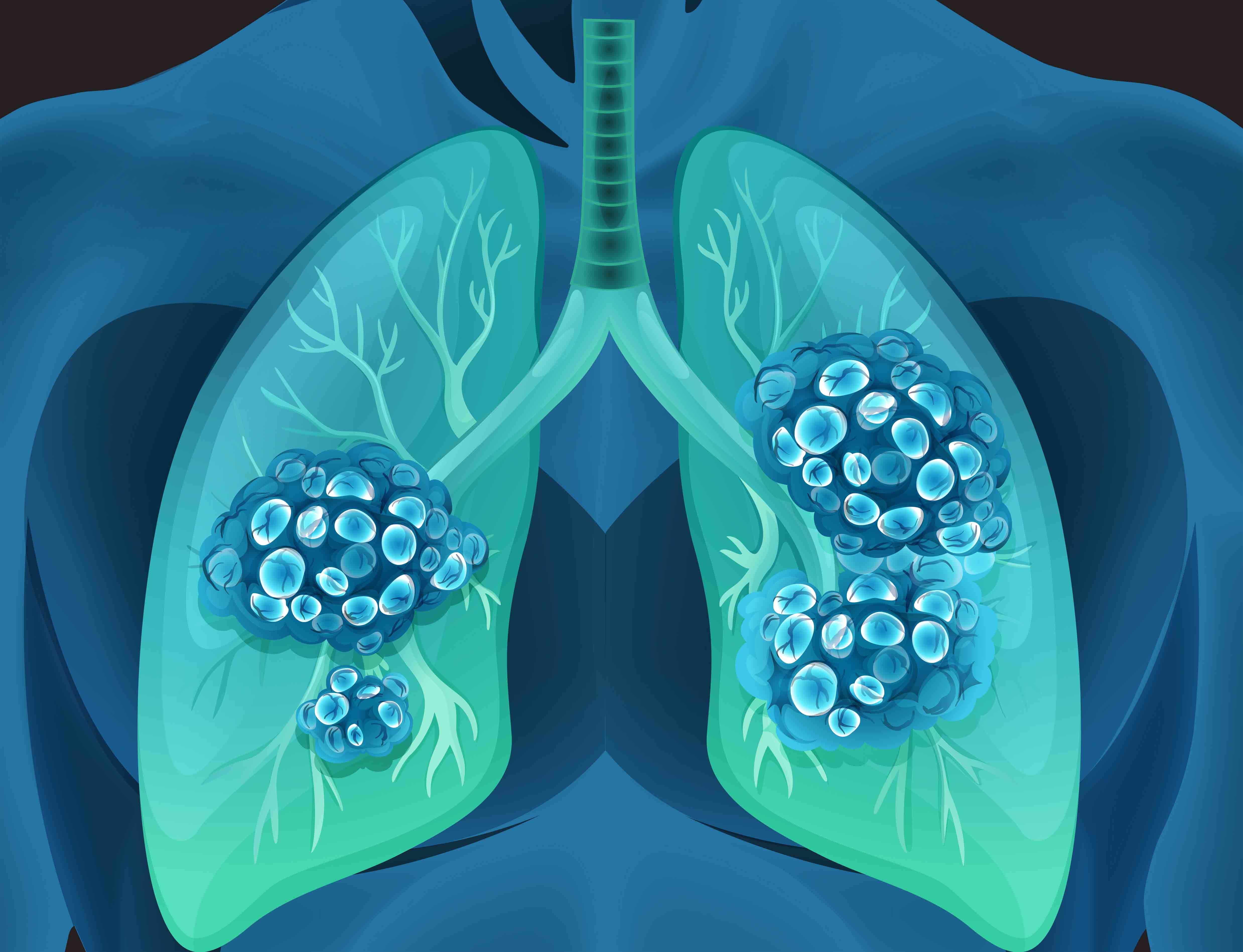 5 Lesser Known Causes Of Lung Cancer