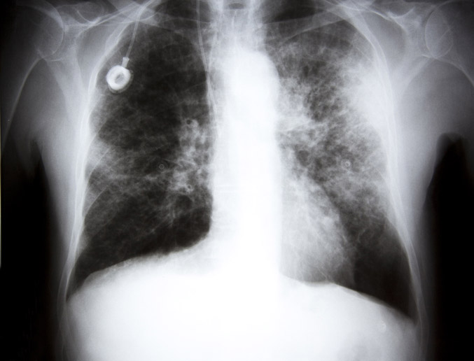 Lung cancer x-ray