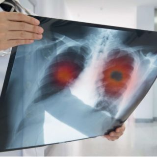 Doctor examines lung x-ray