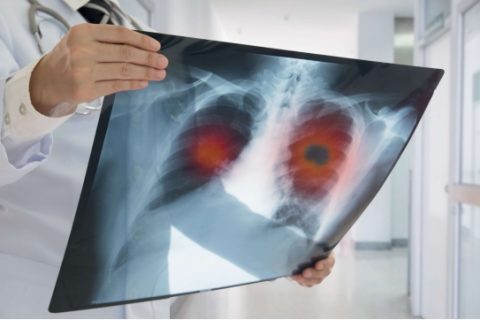 Doctor examines lung x-ray