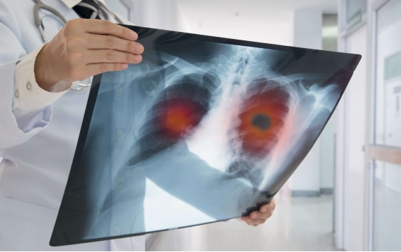 Doctor examines lung x-ray