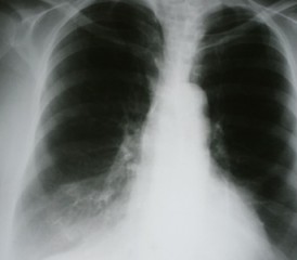 X-ray of lungs