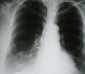 X-ray of lungs X-ray of lungs