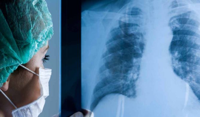 Doctor examines X-ray of lungs