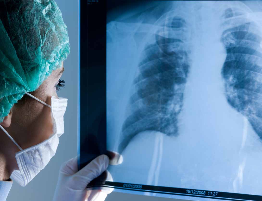 Doctor examines X-ray of lungs