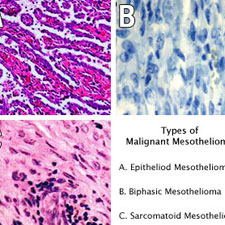 Malignant mesothelioma histology