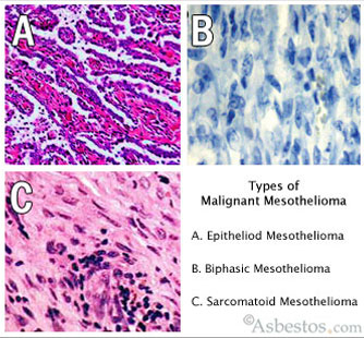 what is the prognosis for stage 4 liver cancer