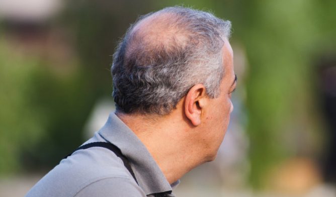 Understanding Impact of Mesothelioma on Hair Loss