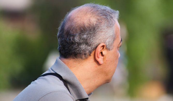 Understanding Impact of Mesothelioma on Hair Loss Understanding Impact of Mesothelioma on Hair Loss