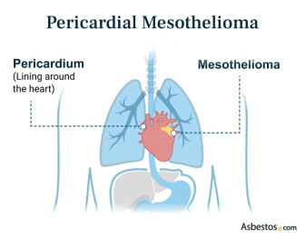 Pericardial Mesothelioma