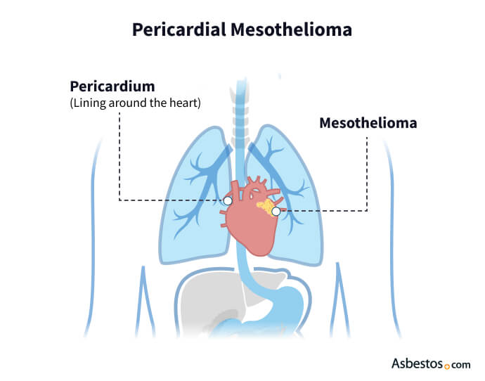 mesothelioma union uk