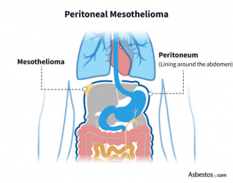 Peritoneal Mesothelioma, the type of mesothelioma affecting the abdomen