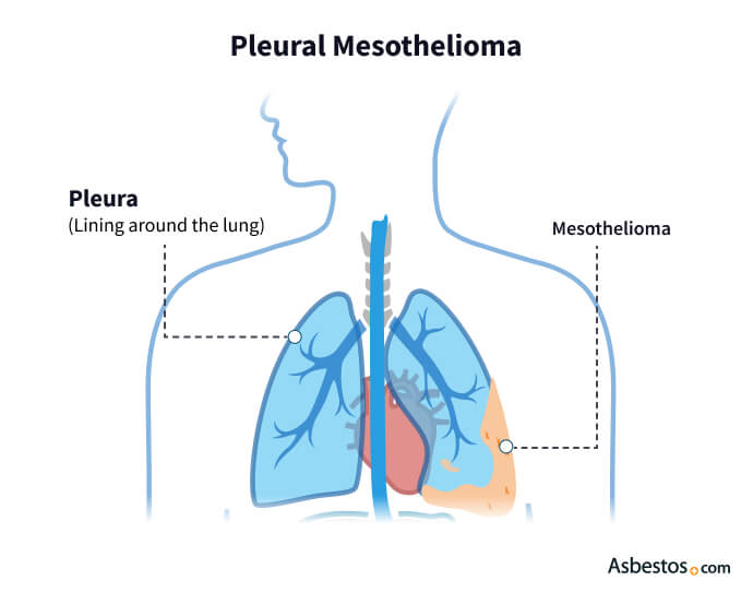 10. What are the different types of mesothelioma treatment options available?