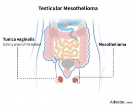 Testicular Mesothelioma, the type of mesothelioma affecting the testes