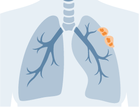 Mesothelioma: What Is Malignant Mesothelioma Cancer?