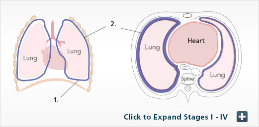 mesothelioma cancer center