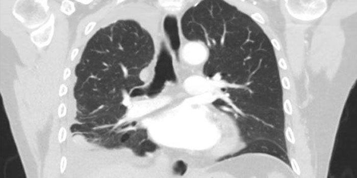 Pleural Mesothelioma CT Scan Pleural Mesothelioma CT Scan