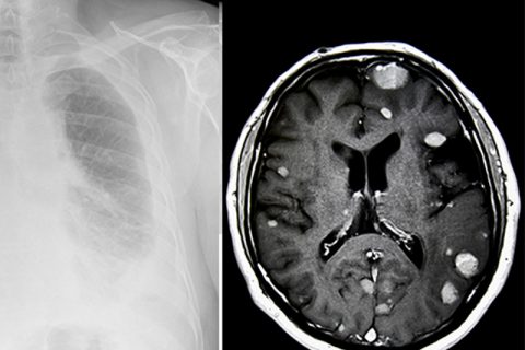 Mesothelioma in lung and brain tumors