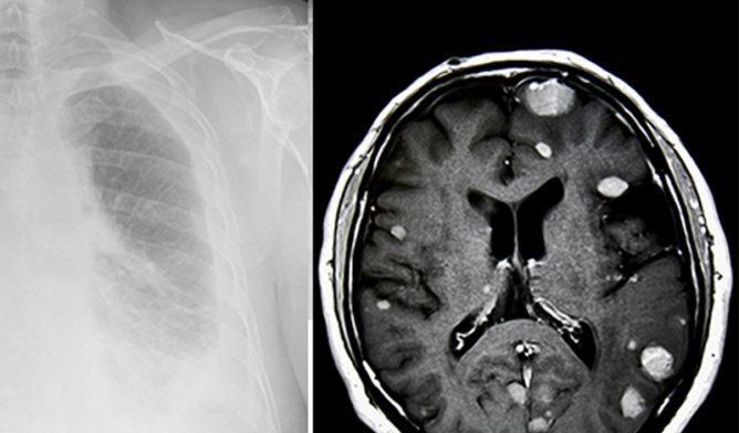 how curable is mesothelioma