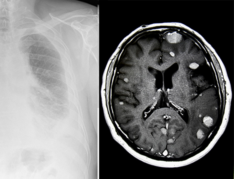 malignant pleural effusion stage 4 cancer