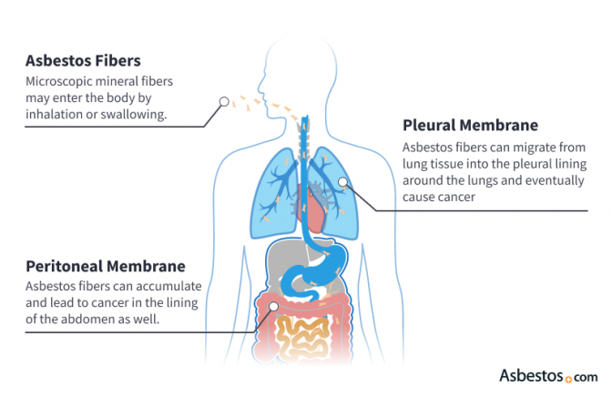 Diagram showing how asbestos develops into pleural and peritoneal mesothelioma