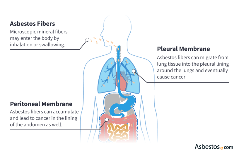 stage 4 lung cancer how long will i live