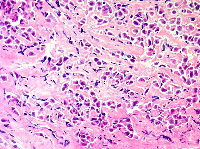 Peritoneal Mesothelioma Grading System Improves Prognosis Peritoneal Mesothelioma Grading System Improves Prognosis
