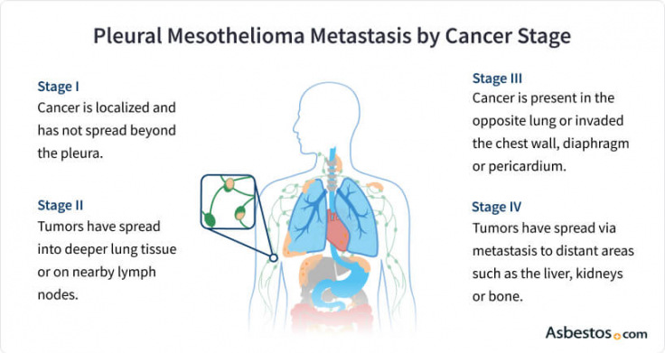 Mesothelioma metastasis by cancer stage