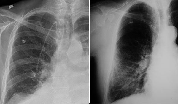 x-ray of mesothelioma vs pneumonia