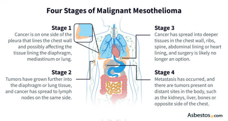 The 4 stages of mesothelioma explained